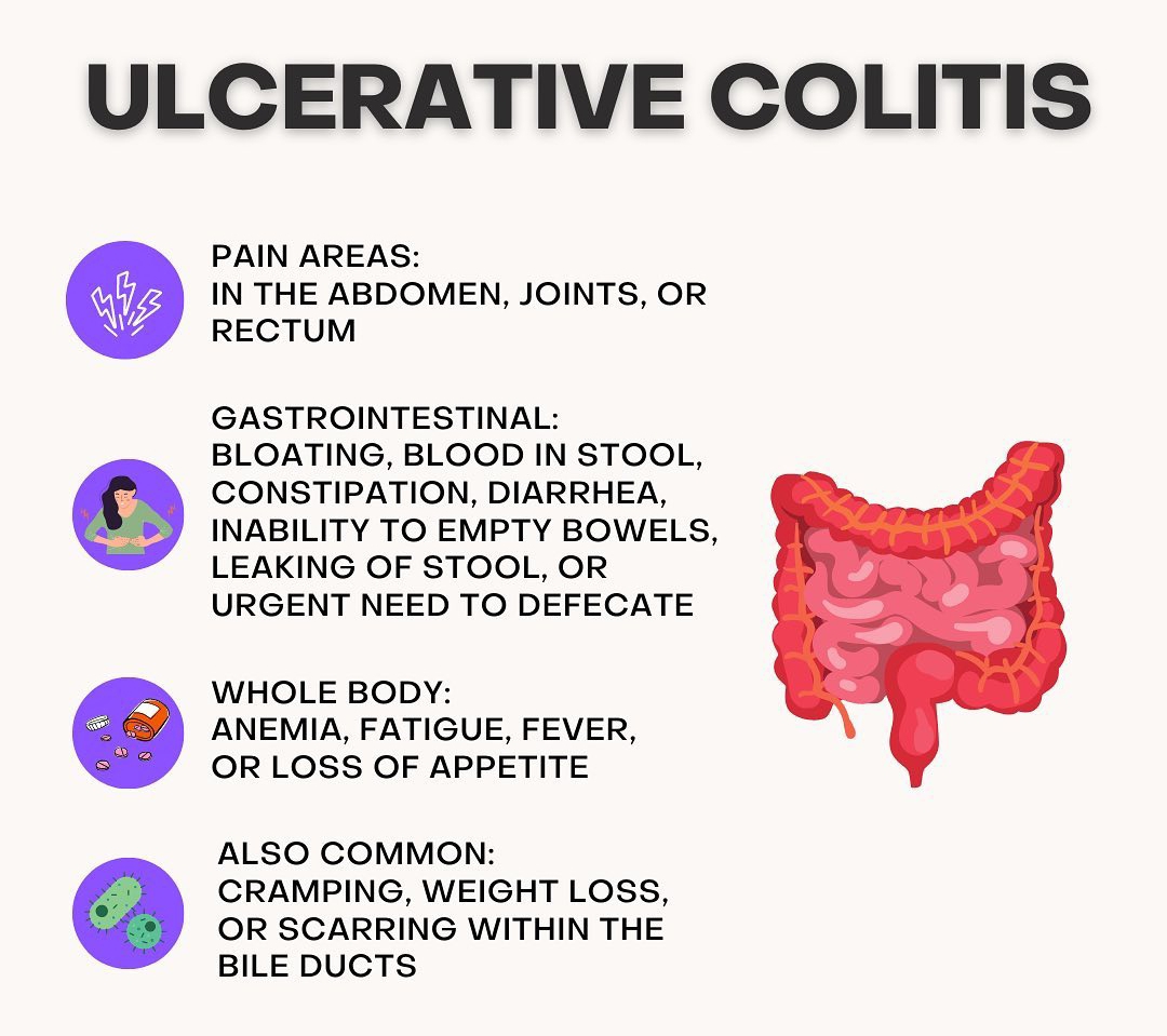 ulcerative colitis