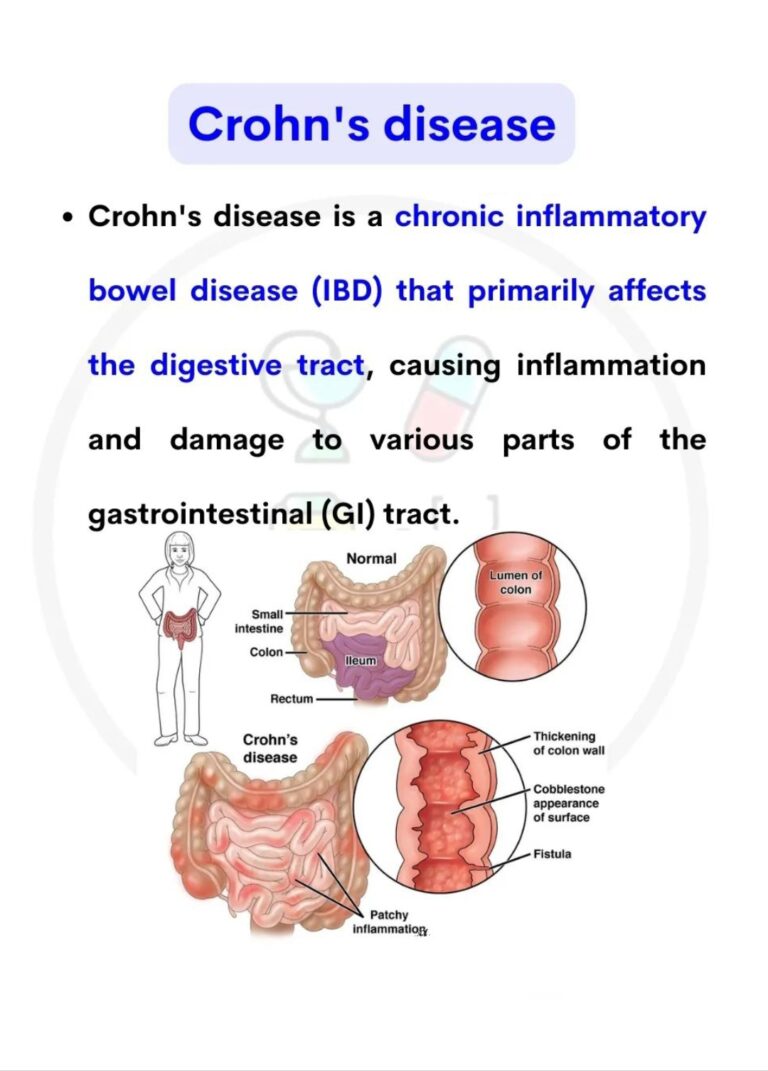 Crohn's Disease